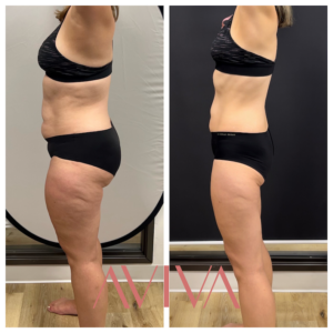 medical weight loss, female patient